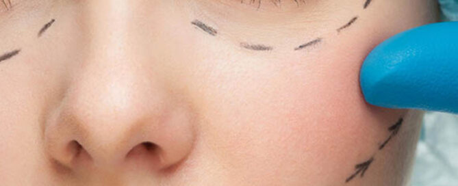 botox face